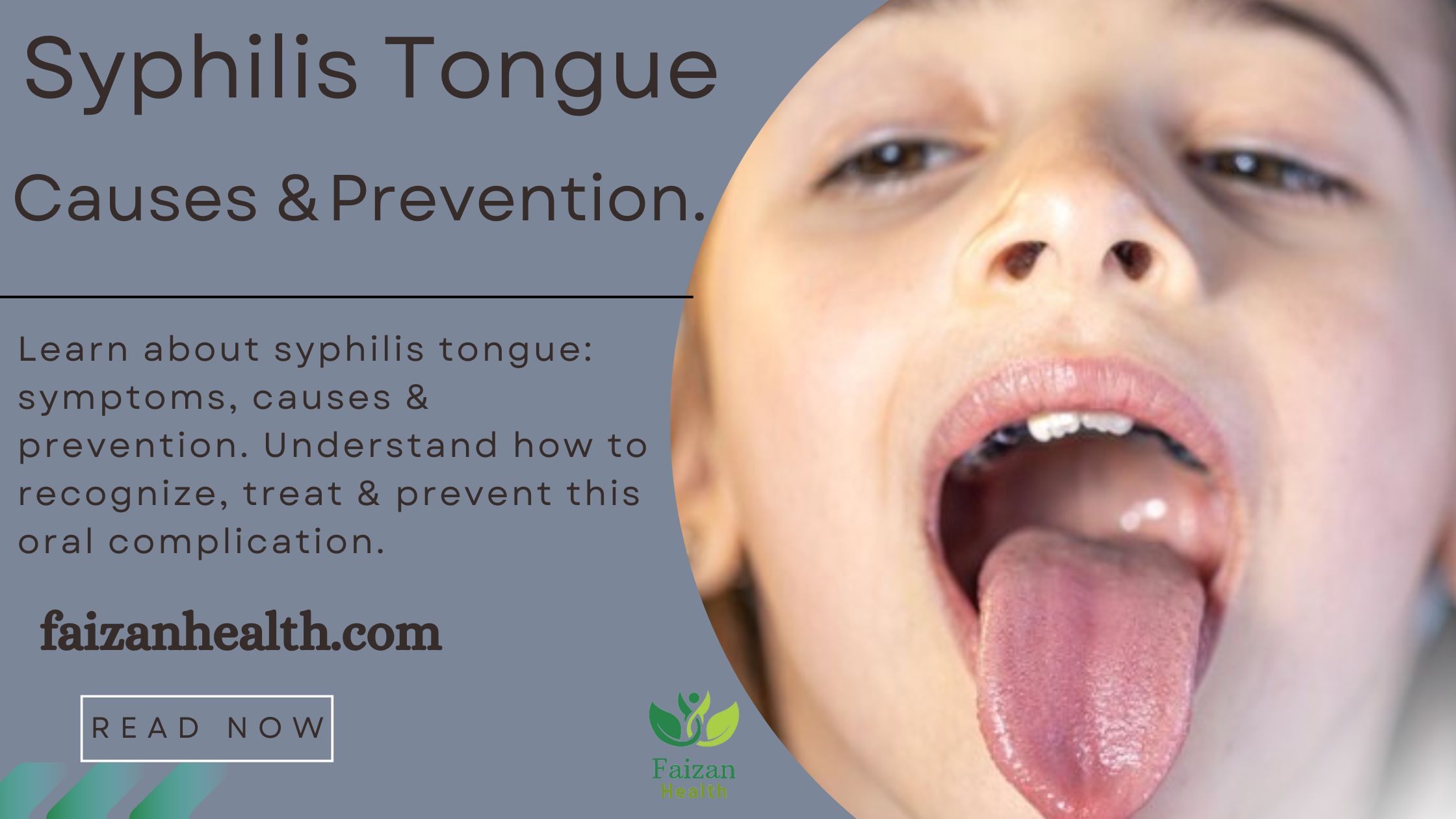 Syphilis Tongue.