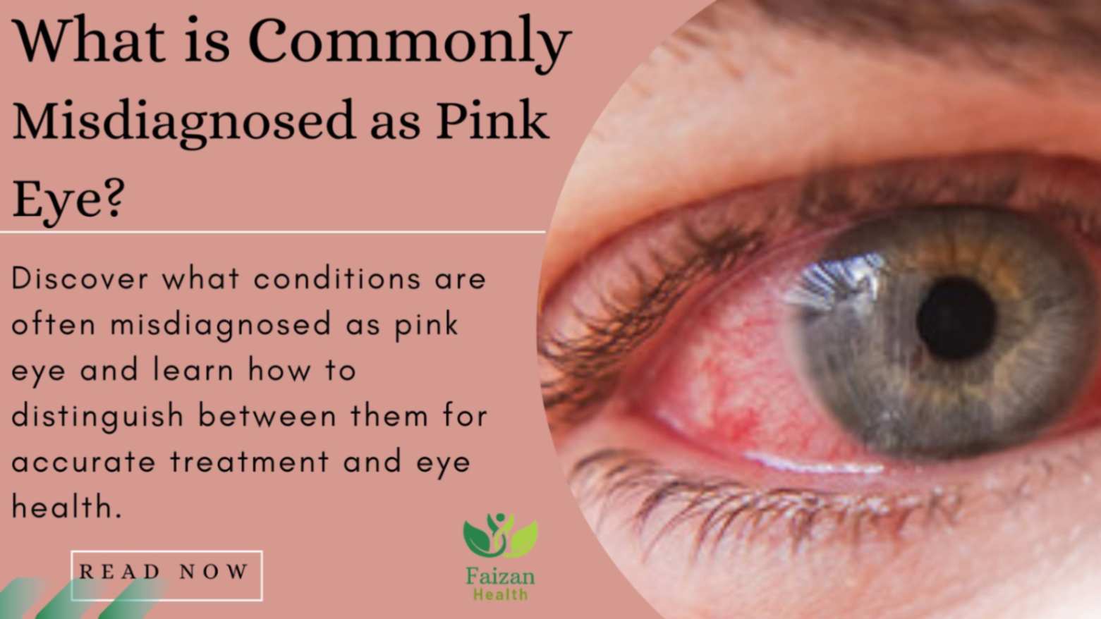 What is Commonly Misdiagnosed as Pink Eye